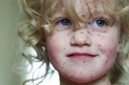 Câte zile au varicela și copii și adulți