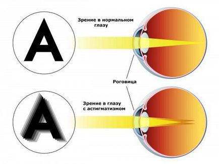 Змішаний астигматизм у дітей лікування вправами гиперметропического і миопического, чи можна