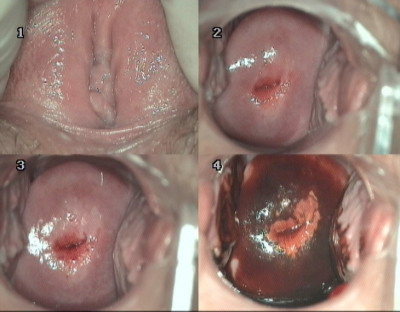 Formele subclinice de papilomavirus