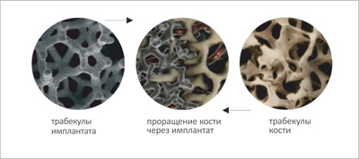 Танталові трабекулярние (губчасті) імплантати класу люкс