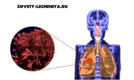 Tuberculoza, cum să tratați tuberculoza cu remedii folclorice