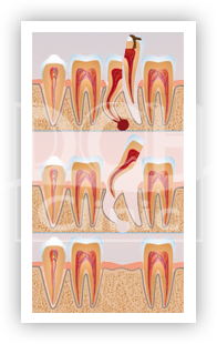 Extracția dentară în stomatologie, reamintire după extracția dinților, bifurcația dinților