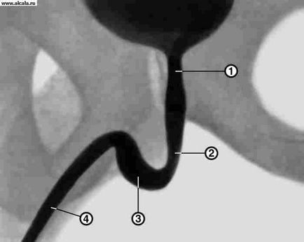 Urethrometer, urethrography Medical Encyclopedia