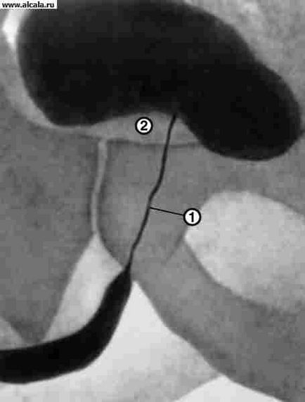 Uretometru, urethrografie, enciclopedie medicală