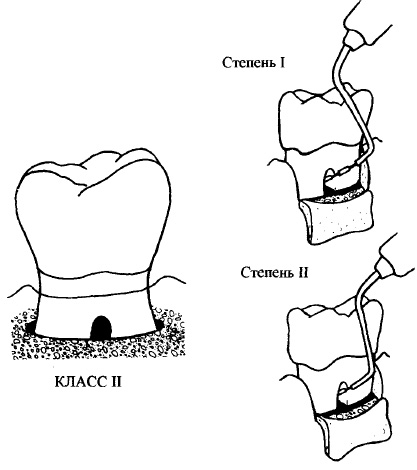 Eliminarea defectelor osoase care implică bifurcare în defect - stomatologie, parodonție -