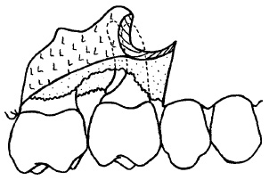 Усунення кісткових дефектів залучення біфуркації в дефект - стоматологія, пародонтологія -