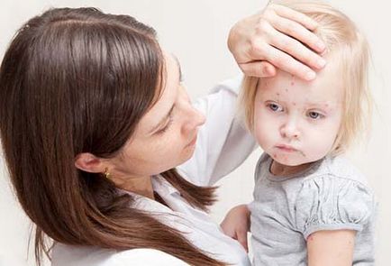 Varicela la copii - simptome și tratament