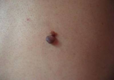 Convex nevus (anyajegy) domború anyajegy