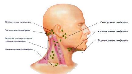 Запалення лімфовузлів на шиї; лікування декількома способами