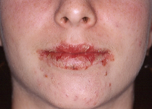 Heilit pe buze fotografii ale formei alergice a bolii și moduri de tratament
