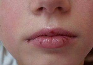 Хейліт на губах фото алергічної форми захворювання і способи лікування