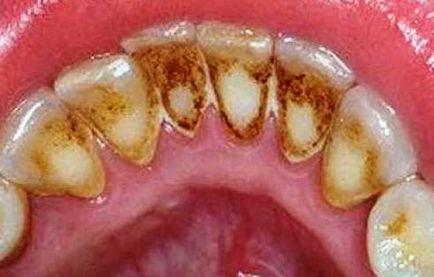 Gum boala fotografii, simptome și tratamentul bolii gingivale