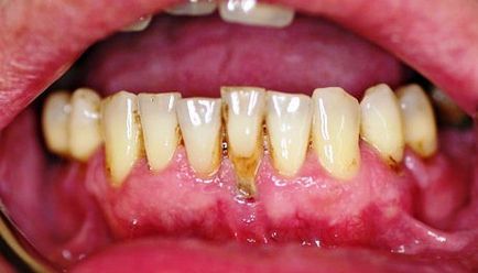Gum boala fotografii, simptome și tratamentul bolii gingivale