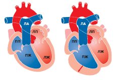 Заняття спортом при кардіоміопатії - лікування серця