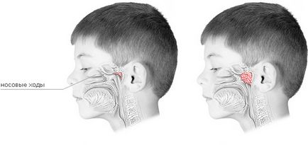 Аденоидит у дітей симптоми і лікування