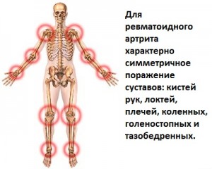 Activitatea simptomelor artritei reumatoide, stadiul bolii