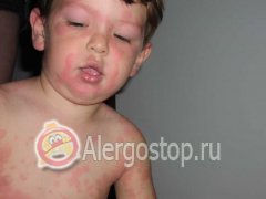 Alergia la vanilină la un copil - alergie