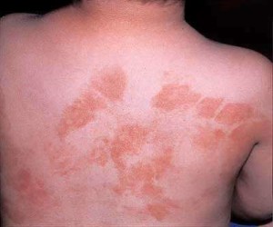 Алергія на йод - симптоми і лікування