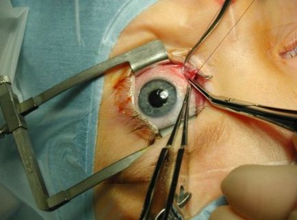 Амбліопія зору - причини і лікування проблеми ледачого ока
