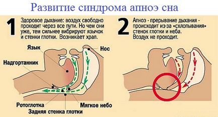 Apneea în tratamentul somnului, cauze, simptome, diagnostic