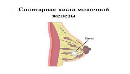 Атипова кіста молочної залози її види та причини виникнення