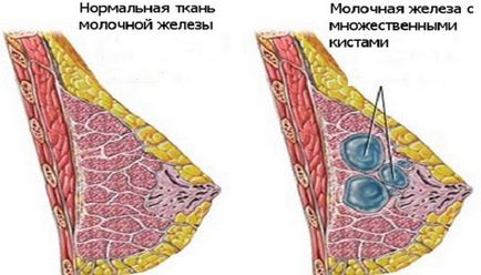 Атипова кіста молочної залози її види та причини виникнення