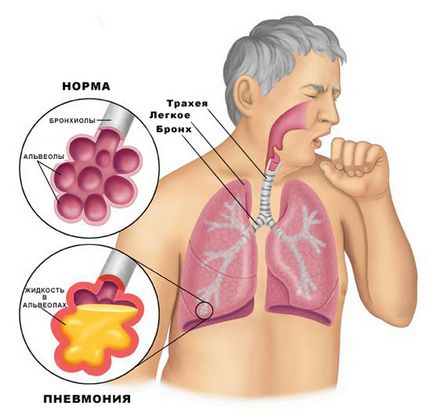 Atipică pneumonie