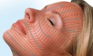 Bioarmificarea feței cu indicații și contraindicații ale acidului hialuronic, recenzii și rezultate