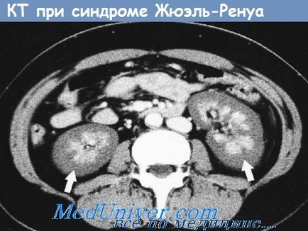 Biopsia rinichilor la copii
