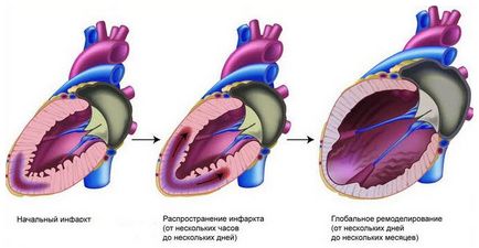 Durerea din spate este infarct miocardic