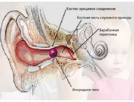 Fülfájás tünetek, diagnózis és kezelések, ingyenes konzultáció a klinikán Dr. Zaitseva