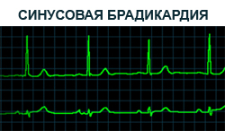 Брадикардія у дітей причини, симптоми, лікування і профілактика