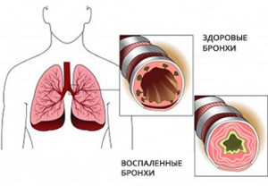 Sindromul bronhoobstructiv cauzează simptome