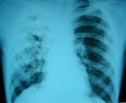 Через скільки проявляється туберкульоз після зараження