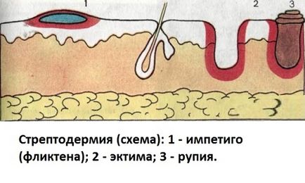 Що являє собою стрептодермія лікування в домашніх умовах