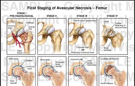 Що таке аваскулярний некроз, health life медіа