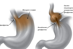Ce este o hernie fixă ​​a deschiderii esofagiene a diafragmei (sub)