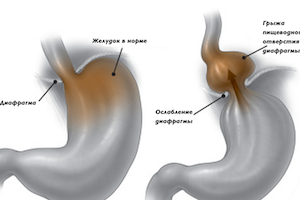 Що таке фіксована грижа стравохідного отвору діафрагми (під)