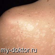 Lichior colorat - o boală periculoasă a pielii