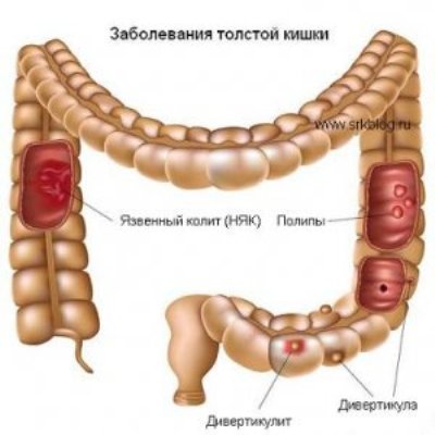 Dieta cu niak (colită ulcerativă), dietă nutrițională și meniu dieta