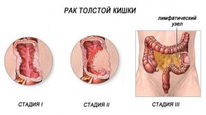 Diéta fekélyes vastagbélgyulladás, élelmiszer, termékek, menü