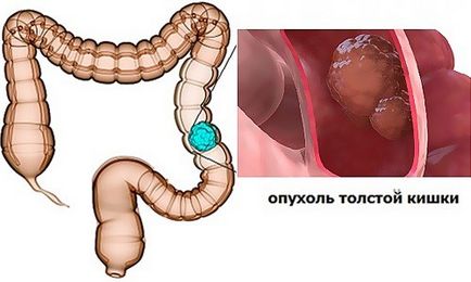 Tumorile benigne ale colonului, cauze, simptome, metode de diagnostic și tratament