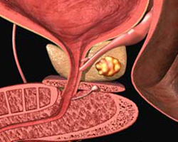 Fibroza - cauze, simptome, diagnostic, tratament