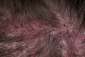 folliculitis dekalviruyuschy