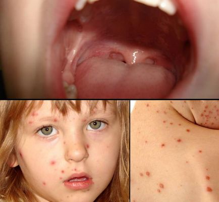 Herpes la copii - fotografii și imagini pe diferite părți ale corpului