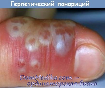 Herpes panaritium - diagnostic, tratament