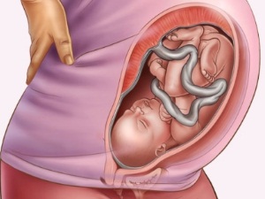 Prezentarea capului fetal (tipuri și exerciții pentru corecție)