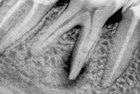 Granulálás periodontitis - okai, tünetei, diagnózisa és kezelése