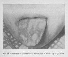 Afecțiuni fungice ale mucoasei orale, parodontitei și parodontitei, tratamentul bolilor