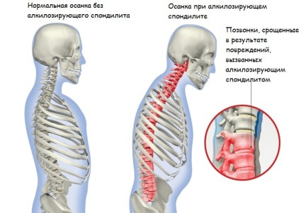 Thoracic coloanei vertebrale, structura și exerciții de gimnastică pentru tratament